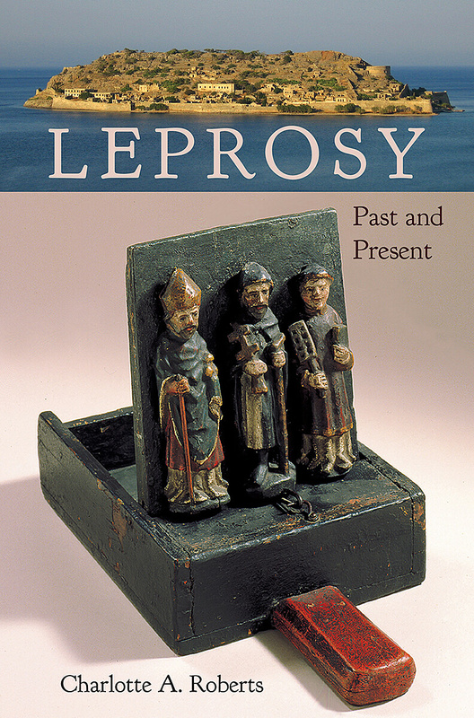 Leprosy